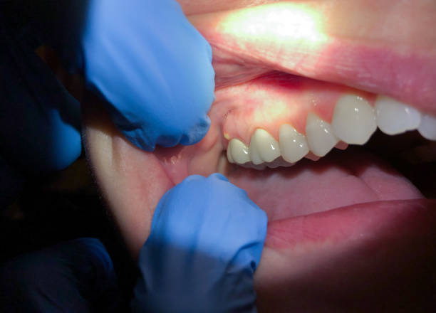 Best Emergency Dental Care for Abscessed Tooth in Bishop, CA